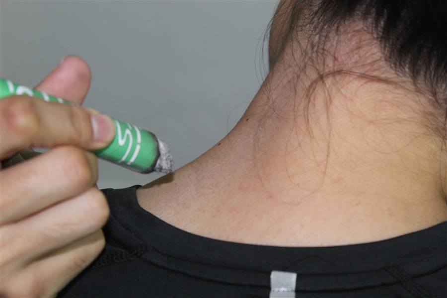 Real moxibustion photo